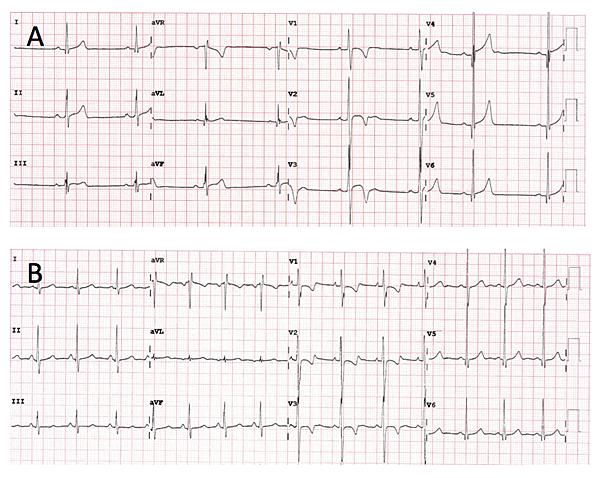Review article 9 Figure 1: (A) Anterior T wave inversion preceded by J point elevation in an asymptomatic 18-year-old black footballer. This is a normal repolarisation pattern in black athletes.