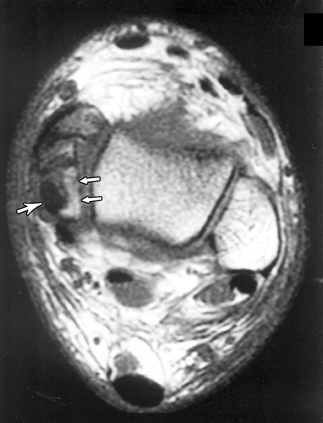 In a second patient, tenosynovitis of the anterior tibial tendon and impingement were shown associated with a distal tibial interlocking screw head (Fig. 5).