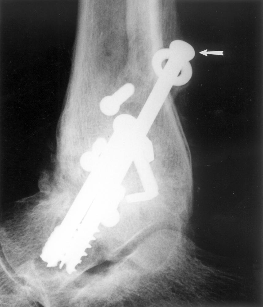 CT can provides excellent imaging of bone abnormalities but provides less optimal imaging of tendon abnormalities.