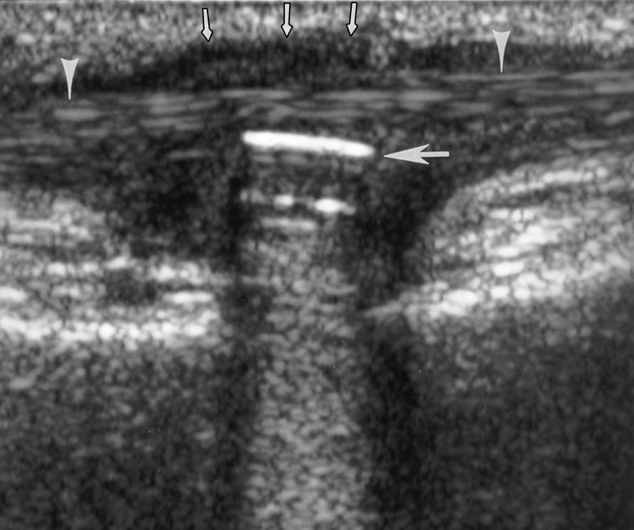 Sonography of nkle Tendon Impingement Downloaded from www.ajronline.org by 162.158.89.91 on 08/23/18 from IP address 162.158.89.91. Copyright RRS.