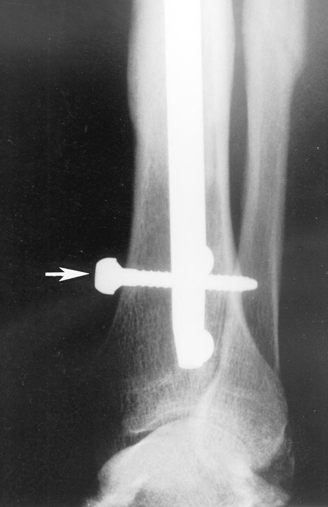 Radiographs can provide clues regarding possible tendon impingement on the basis of the expected tendon anatomy in the region of the hardware.