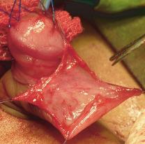 To Evaluate the Role of Vascularised Dorsal Dartos Flap in Snodgrass Urethroplasty 33 of the patient was inserted into the bladder against which a neourethra was constructed by using subcuticular