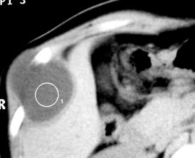 The CT scan: cystic lesion in soft tissues, described as homogeneous and isodense with liquor, (4 patients) inhomogeneous and hyperdense (2 patients in our study), or
