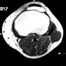 MRI MRI signal intensity pattern of the hydatid cysts reflects their contents.