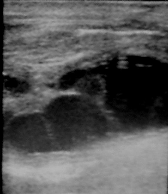 Diagnosis was highly suspected on ultrasonography in 6 patients, showing: unilocular cyst lesion in 1 case and multilocular cyst (fig.