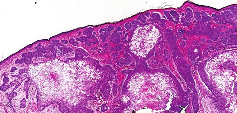 2 Figure 1: Low-power examination revealed a dermal basaloid tumor that comprised nests with clear cell changes present.