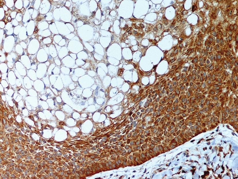 3 Figure 6: The peripheral basal cells are strongly positive with Bcl-2 protein immunostaining. The central clear cells are focally positive.