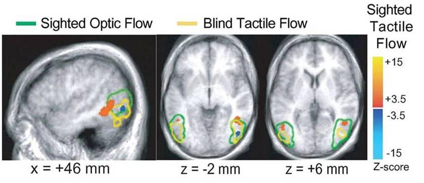 Tactile motion: summary Sighted Optic Flow Blind Optic Flow Sighted Tactile Flow Tactile flow perception in sighted subjects activated the more anterior part of hmt+ but deactivated the more