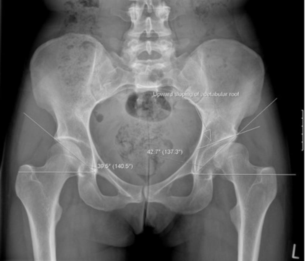 Fig. 7: AP radiograph of pelvis. There is upward sloping of the left, superior acetabulum, with lateralization of the femoral head. The joint spaces are preserved.