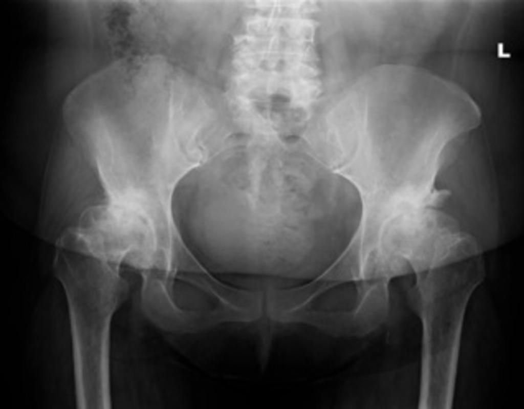 point to the most lateral point. It should not be greater than 10 degrees. This is illustrated in figure 8. Figure 8 - AP radiograph of same patient as in figures 6 and 7.