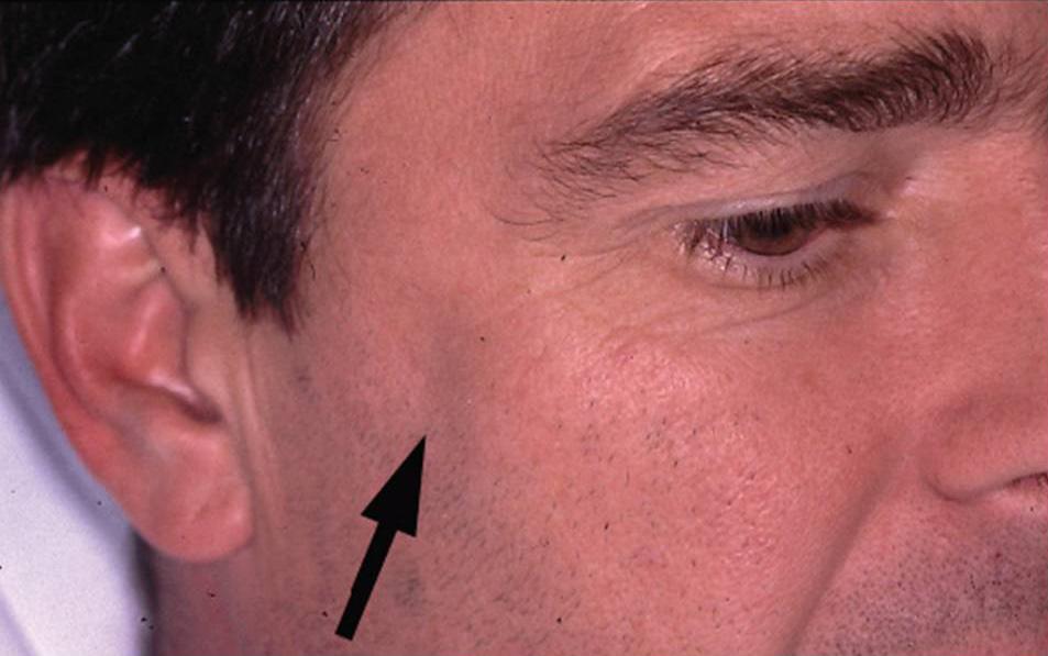 Fig. Fractured zygomatic arch.