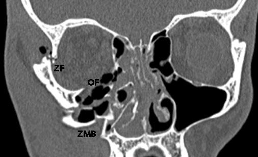 The force applied was anterior posterior in direction (arrow) and the zygomatic bone has rotated around the temporozygomatic suture (TZ) resulting in a posteromedial displacement.