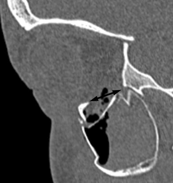 There are fragments of bone (OF) together with blood in the maxillary antrum, highly suggestive of an additional orbital floor fracture. Fig.