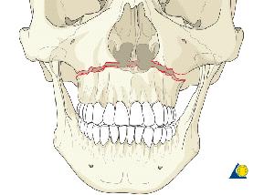+ Le Fort I Upper alveolus becomes separated from upper