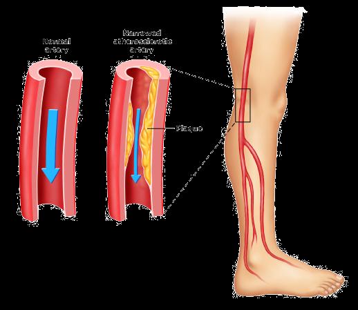 Introduction to Peripheral Arterial Disease Stacey