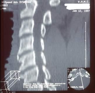 Obstruction C-spine CTs 10 Blood Loss All Le Fort