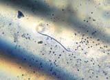 Filarial Worms Elephantiasis Victims Lymphatic filariasis,, also known as elephantiasis, is best known from dramatic photos of