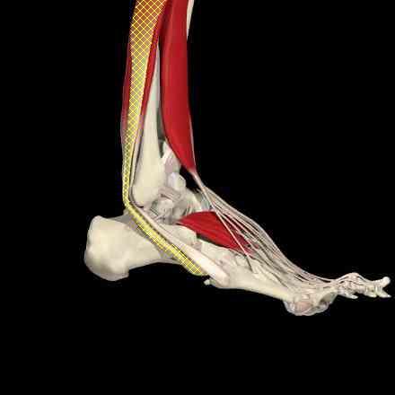 Cuboid Syndrome Pain runs along the lateral aspect of the foot, up around the back of