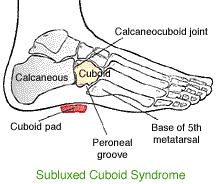 Cuboid Syndrome Treatment includes a pad tapped