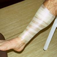 Posterior Tibial Tendonitis Treatment includes reducing inflammation by using NSAID s, ice,