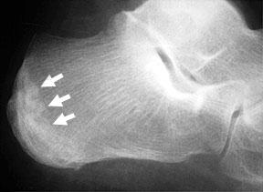 Sever s Disease/Calcaneal Stress Fracture X-ray showing the stress fracture.