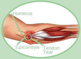 Medial Epicondylitis Irritation of medial epicondyle from overuse of pronation and flexion muscles May irritate