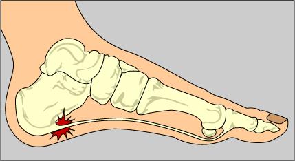 Plantar Fascitis A tear of the plantar fascia on the bottom of the foot at
