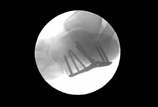Tornier WAVE Calcaneal fracture plate system
