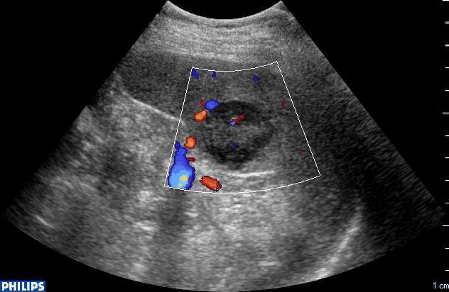 Staging in a patient with HL: focus on spleen (FDG PET + )