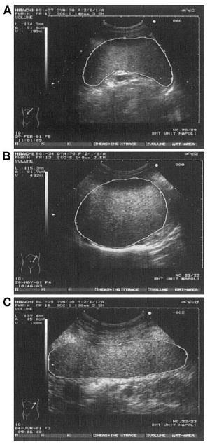 Ultrasonography-measured longitudinal diameter Results in 30% of falsenegative findings* Spleen may have
