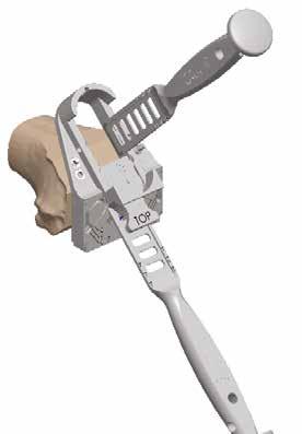 Please note that peg position does not change between size 1 and 1+, 2 and 2+, and so on. OPTION The femoral trochlear-milling guide can be used also with the osteotome.