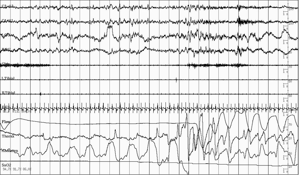 Polysomnography of a
