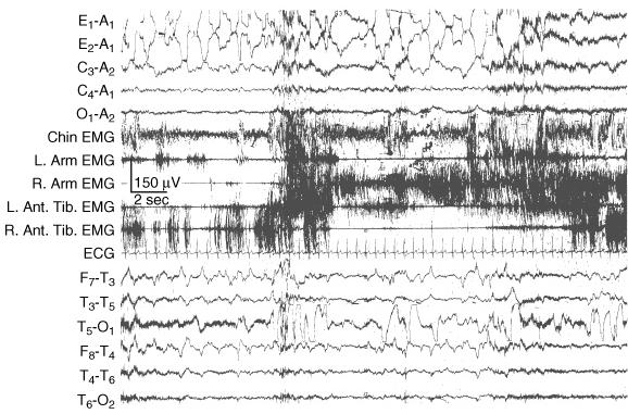 Polysomnography of a 68