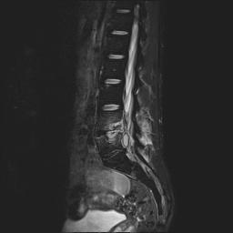 Spine MRI