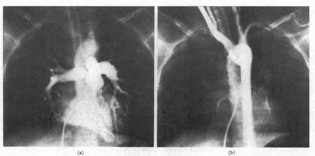 Aortography in Fallot's Tetralogy and Variants FIG. l.