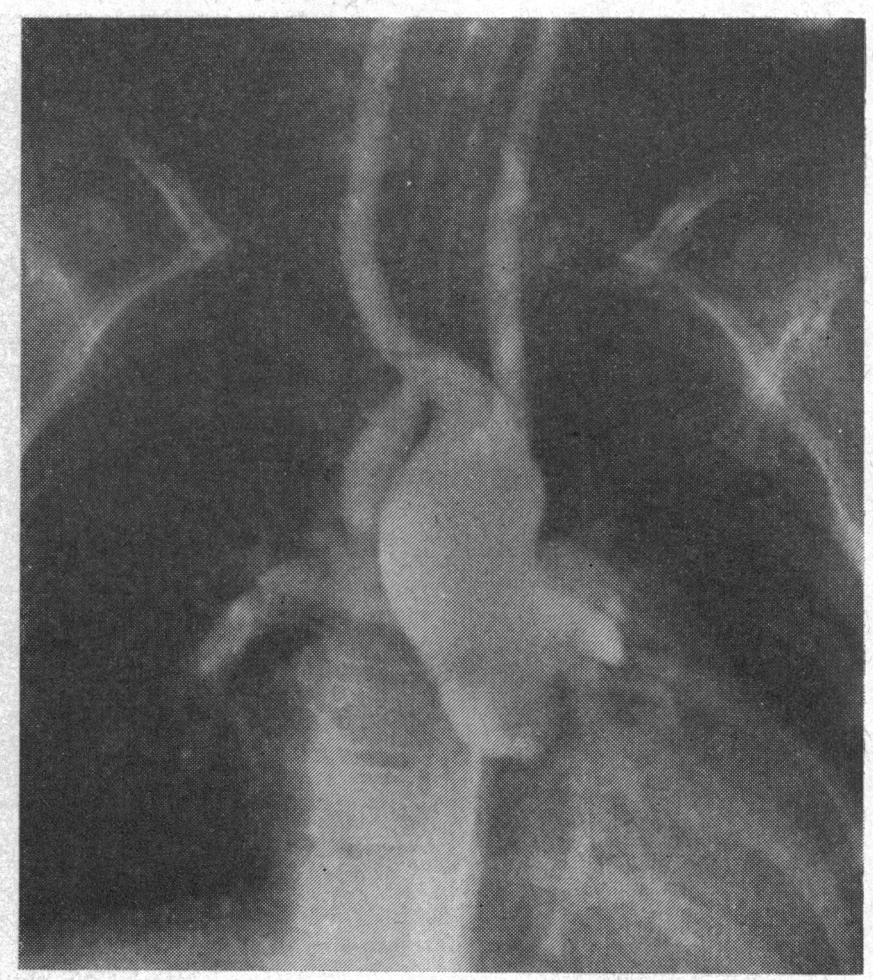 Aortography in Fallot's Tetralogy and Variants 149 FIG. 6.