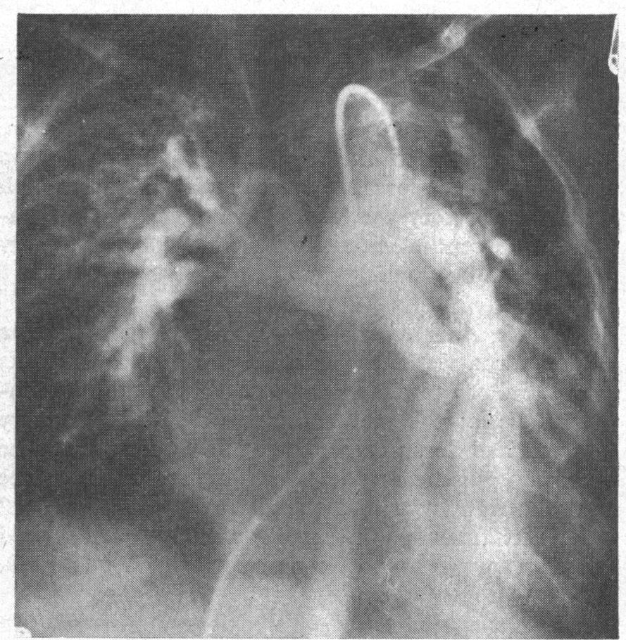 right Blalock anastomosis. Br Heart J: first published as 10.1136/hrt.31.2.146 on 1 March 1969.