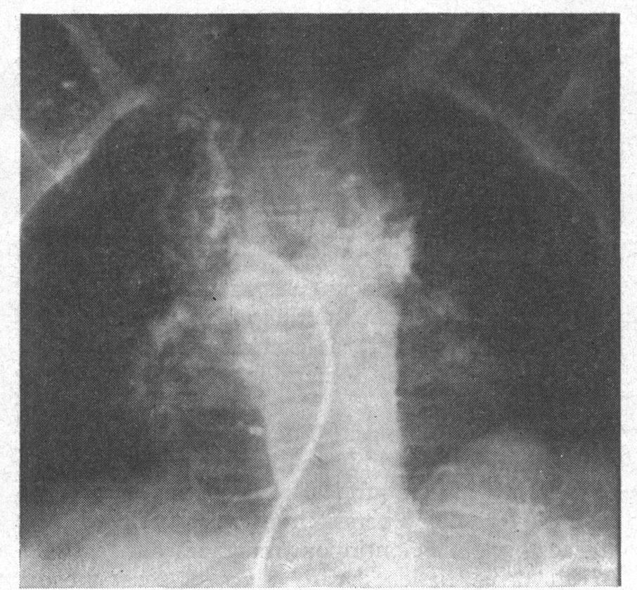 -Aortogram (frontal view) in a patient with pulmonary atresia, showing numerous systemic-pulmonary collaterals -with