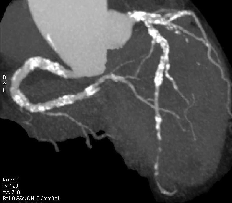 Calcified Coronary Arteries Intuitive for CVS Risk Look for disease Concept used elsewhere Calcified Atherosclerosis The End