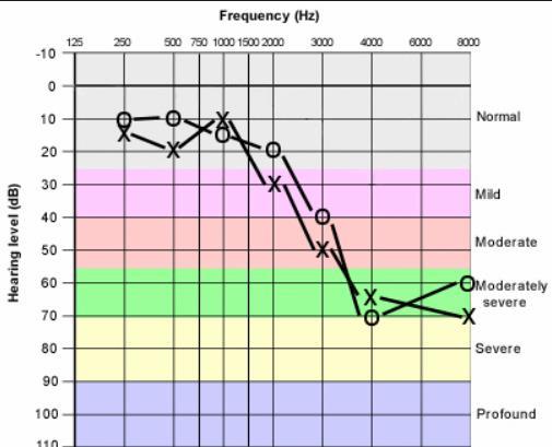 Sample Audiograms High Frequency