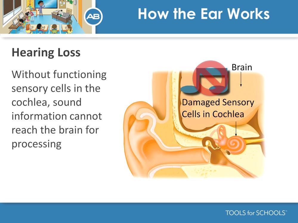 Speakers Notes: Hearing loss involves damage to the sensory cells of the inner ear, referred to as a sensorineural hearing loss.