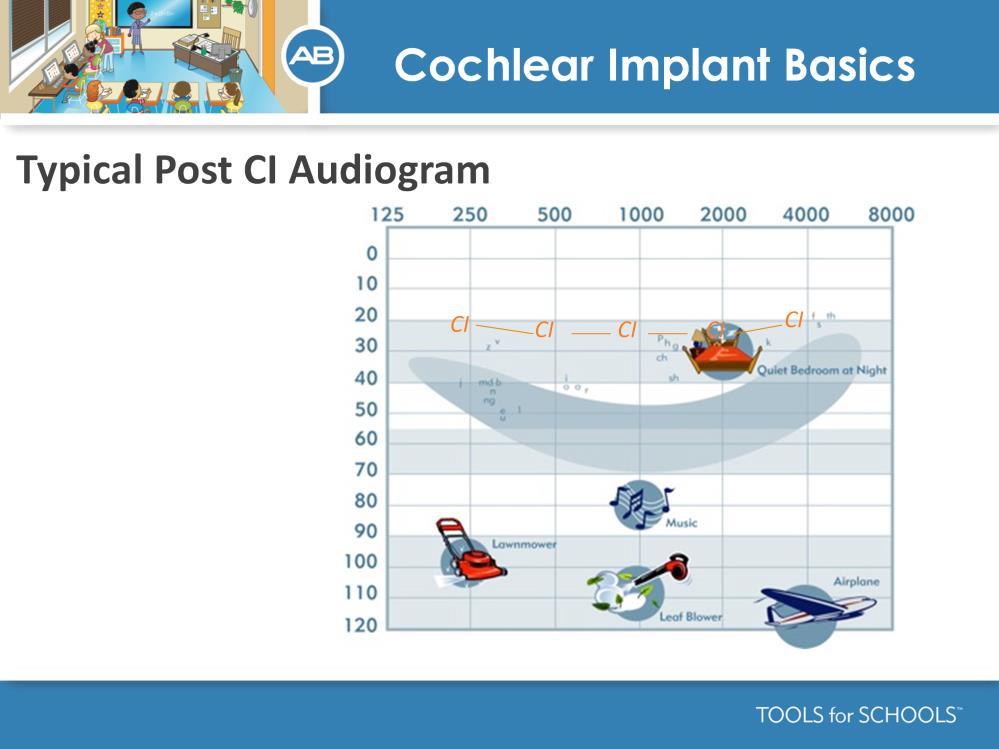 Speaker s Notes: This is a typical audiogram for a child after