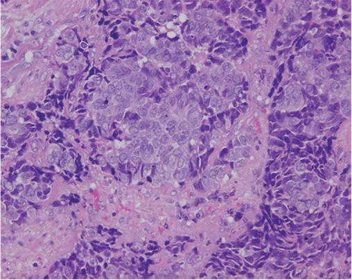 2 (c) Figure 1: Representative histopathologic findings in the surgical specimen of the left lacrimal gland. H-E staining showed invasive proliferation of atypical small cells with rosette formation.