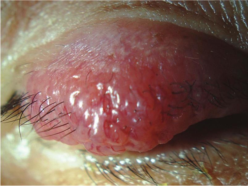 3 Figure 3: Clinical appearance of the right upper eyelid tumor. The painless, reddish, papillary, and solid 30 15 mm size nodule was observed in the right upper eyelid.