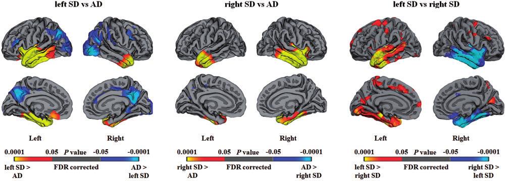 Left- versus right-lateralized SD BRAIN 2016: 139; 986 998 991 Figure 1 Baseline neuroimaging findings showing regions of cortical thinning between diagnostic groups.