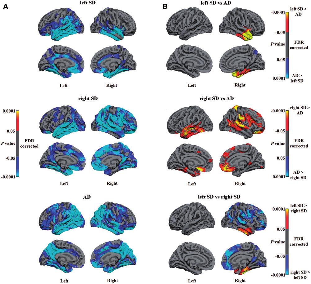 992 BRAIN 2016: 139; 986 998 F. Kumfor et al. Figure 2 Longitudinal changes in cortical thickness according to diagnostic group.
