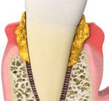 bone and the periodontal ligament (the ligament between the teeth and the jaw bone). In the first stage, the gum becomes inflamed.
