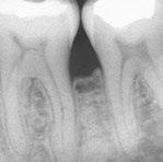 Bone defect caused by gum disease* * * Initial diagnosis Gum disease has caused a pronounced bone
