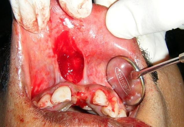 3 This case report describes a technique where soft tissue onlay graft is used for esthetic repair of a ridge defect.