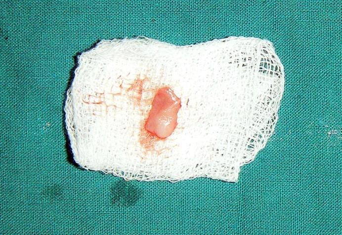 The prepared recipient site was covered with sterile guaze moistened with saline. The palate was selected as the donor site. The template was placed on the donor site.